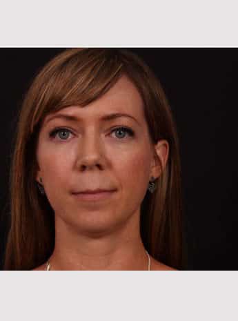 Before Image: Lip Lift - front