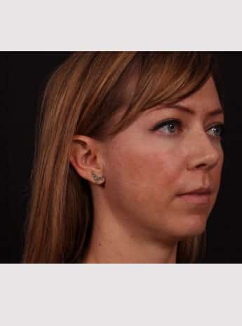 After Image: Lip Lift - right-front-oblique