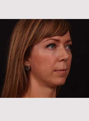 Before Image: Lip Lift - right-front-oblique