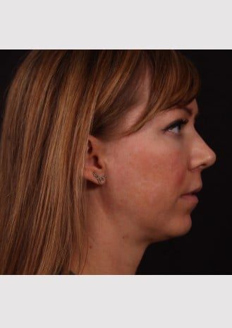 After Image: Lip Lift - right-side