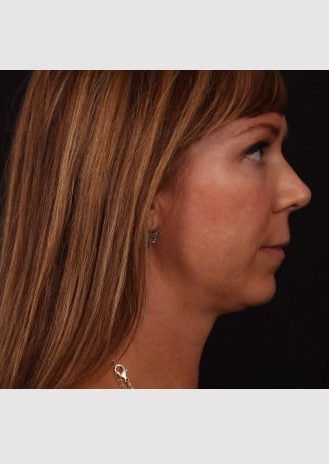 Before Image: Lip Lift - right-side