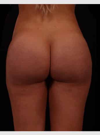After Image: Brazilian Butt Augmentation (Butt Lift) - back