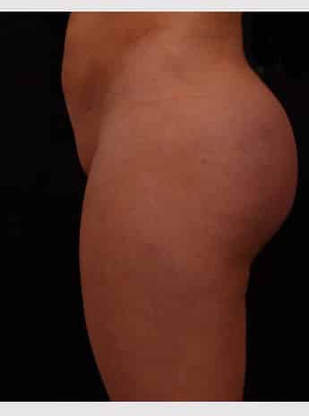 After Image: Brazilian Butt Augmentation (Butt Lift) - left-side