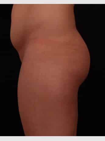 Before Image: Brazilian Butt Augmentation (Butt Lift) - left-side