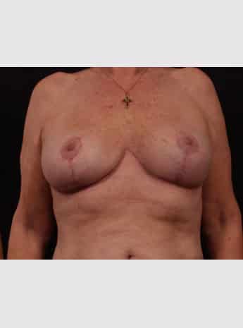 After Image: Secondary Breast Surgery - front