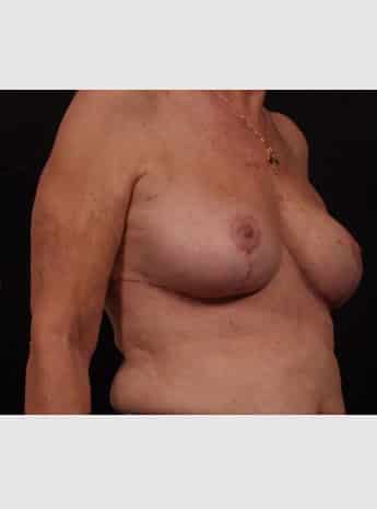 After Image: Secondary Breast Surgery - right-front-oblique