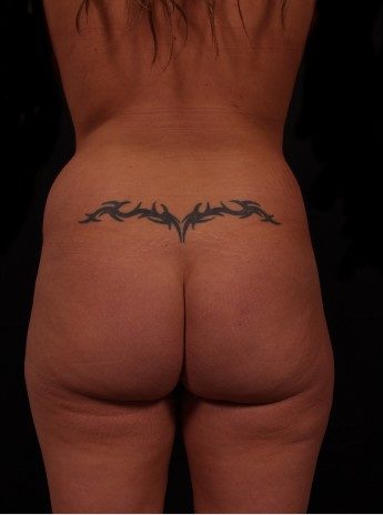 Before Image: Brazilian Butt Augmentation (Butt Lift) - back