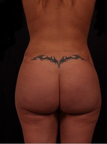 After Image: Brazilian Butt Augmentation (Butt Lift) - back