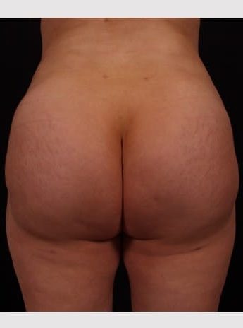 After Image: Brazilian Butt Augmentation (Butt Lift) - back