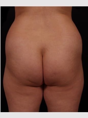 Before Image: Brazilian Butt Augmentation (Butt Lift) - back