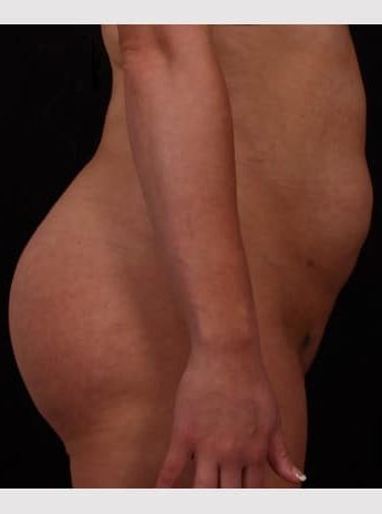 After Image: Brazilian Butt Augmentation (Butt Lift) - right-side