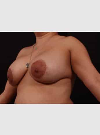 Before Image: Secondary Breast Surgery - left-front-oblique
