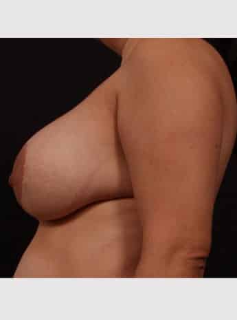 Before Image: Secondary Breast Surgery - left-side