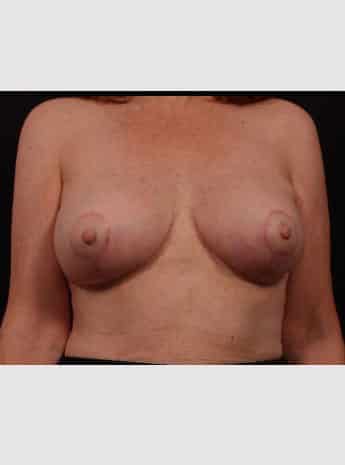 Secondary Breast Surgery