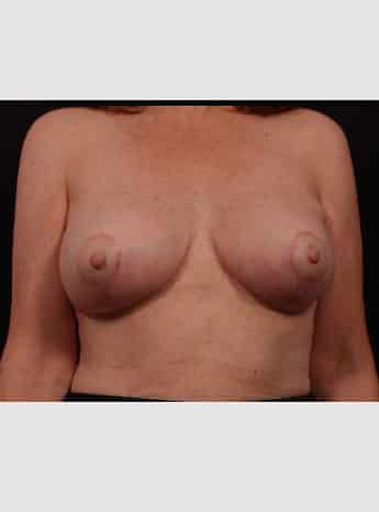 After Image: Secondary Breast Surgery - front