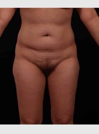 Before Image: Tummy Tuck (Abdominoplasty) - front