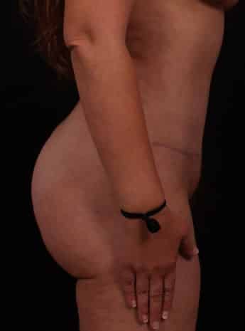 After Image: Tummy Tuck (Abdominoplasty) - right-side