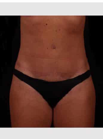 After Image: Tummy Tuck (Abdominoplasty) - front