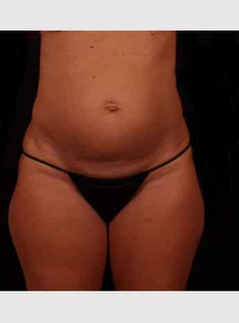 Before Image: Tummy Tuck (Abdominoplasty) - front
