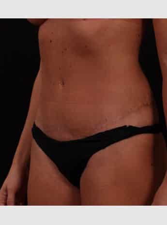 After Image: Tummy Tuck (Abdominoplasty) - left-front-oblique