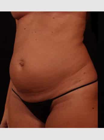 Before Image: Tummy Tuck (Abdominoplasty) - left-front-oblique
