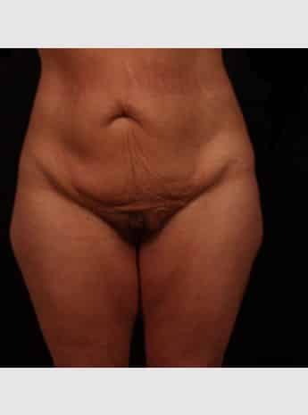 Before Image: Tummy Tuck (Abdominoplasty) - front