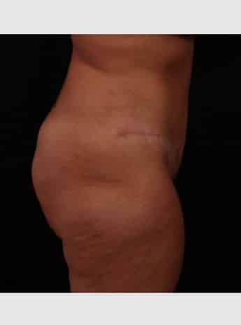 After Image: Tummy Tuck (Abdominoplasty) - right-side