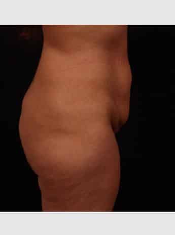 Before Image: Tummy Tuck (Abdominoplasty) - right-side