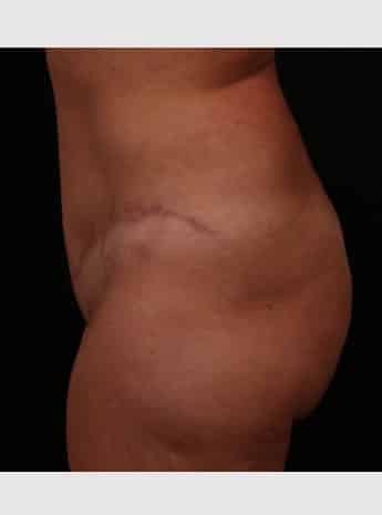 After Image: Tummy Tuck (Abdominoplasty) - left-side