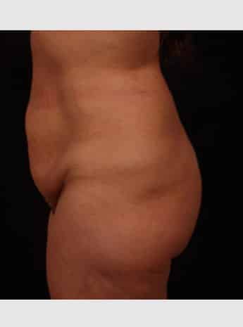 Before Image: Tummy Tuck (Abdominoplasty) - left-side