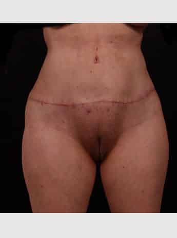 After Image: Tummy Tuck (Abdominoplasty) - front