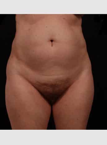 Before Image: Tummy Tuck (Abdominoplasty) - front