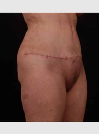 After Image: Tummy Tuck (Abdominoplasty) - right-front-oblique