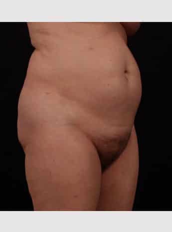 Before Image: Tummy Tuck (Abdominoplasty) - right-front-oblique