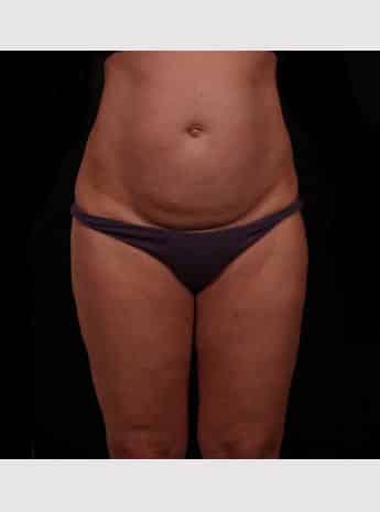 Before Image: Tummy Tuck (Abdominoplasty) - front
