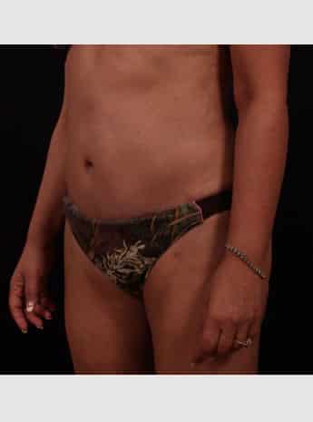 After Image: Tummy Tuck (Abdominoplasty) - left-front-oblique