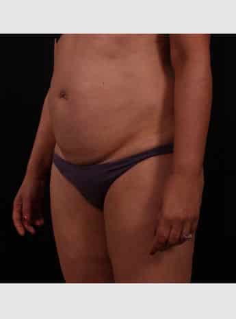 Before Image: Tummy Tuck (Abdominoplasty) - left-front-oblique