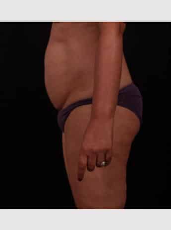 Before Image: Tummy Tuck (Abdominoplasty) - left-side
