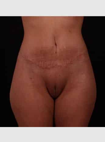 After Image: Tummy Tuck (Abdominoplasty) - front