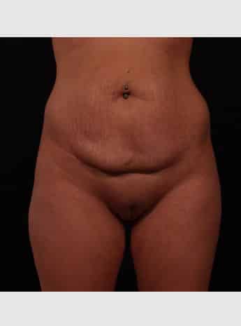 Before Image: Tummy Tuck (Abdominoplasty) - front