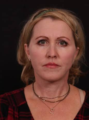 After Image: Neck Lift / Lower Facelift - front