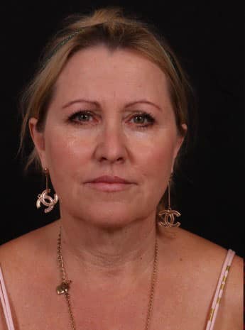 Before Image: Neck Lift / Lower Facelift - front