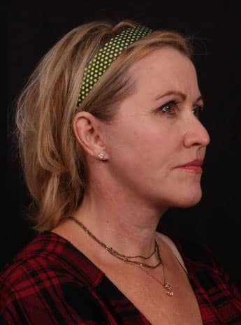 After Image: Neck Lift / Lower Facelift - right-front-oblique