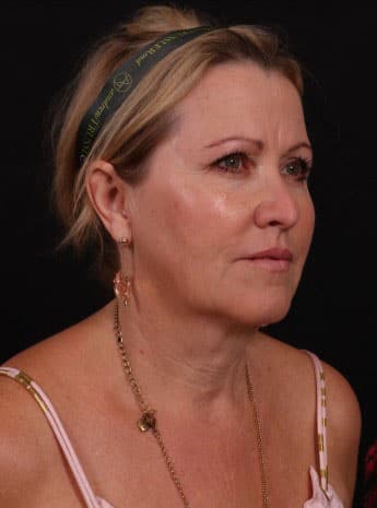 Before Image: Neck Lift / Lower Facelift - right-front-oblique