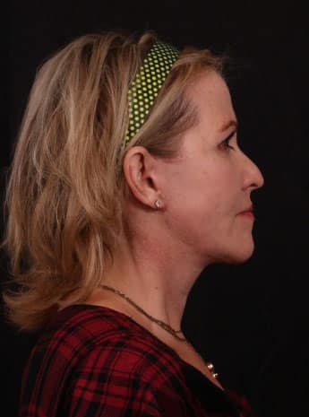 After Image: Neck Lift / Lower Facelift - right-side