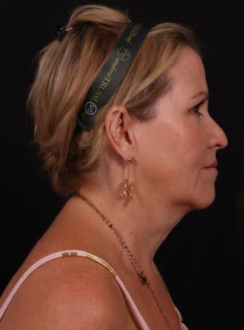 Before Image: Neck Lift / Lower Facelift - right-side