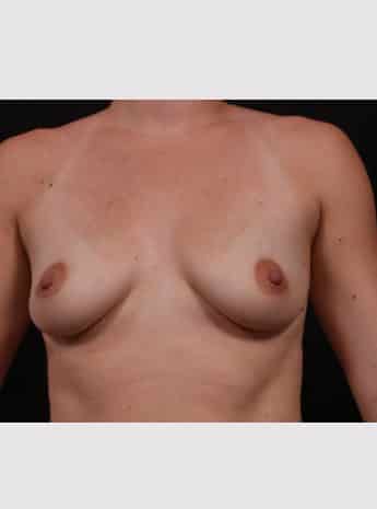 Before Image: Breast Augmentation - front