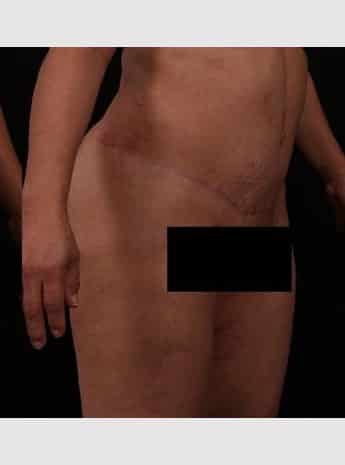 After Image: Tummy Tuck (Abdominoplasty) - right-front-oblique