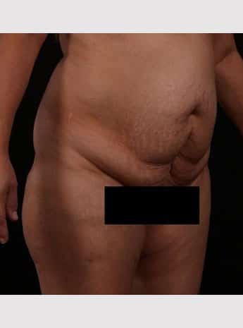 Before Image: Tummy Tuck (Abdominoplasty) - right-front-oblique