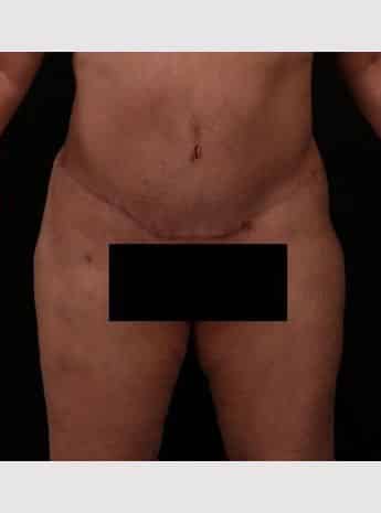 After Image: Tummy Tuck (Abdominoplasty) - front